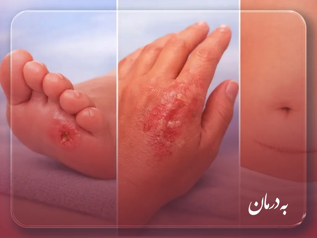 درمان زخم در منزل کرج