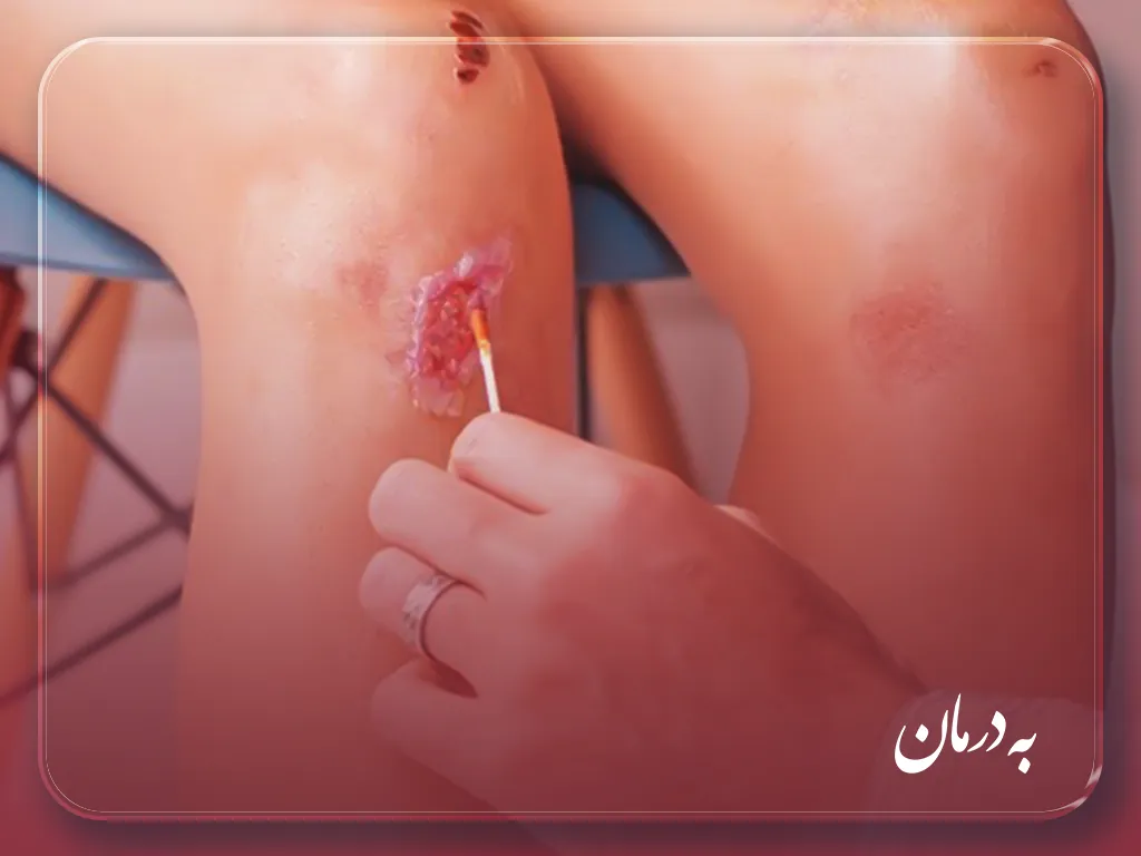 درمان زخم در منزل فردیس