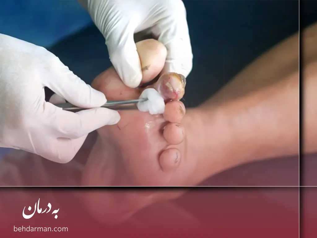 درمان زخم پای دیابتی در تهران